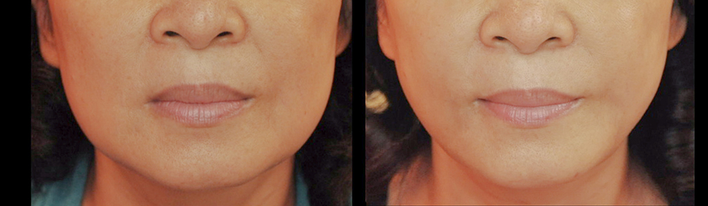 臉部雷射溶脂 案例 3